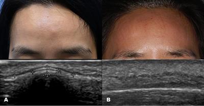 Skin Imaging Using Ultrasound Imaging, Optical Coherence Tomography, Confocal Microscopy, and Two-Photon Microscopy in Cutaneous Oncology